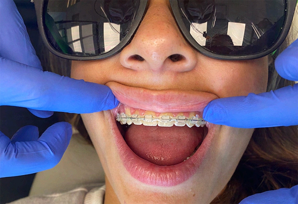 Clear Braces (Ceramic or Sapphire)