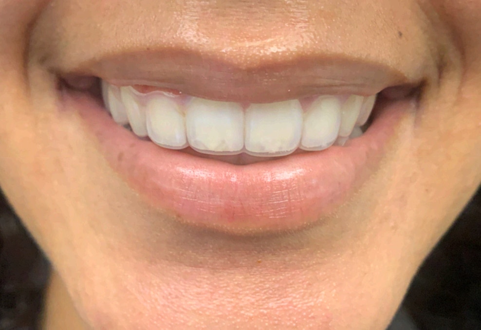 What Types of Retainers are Available?